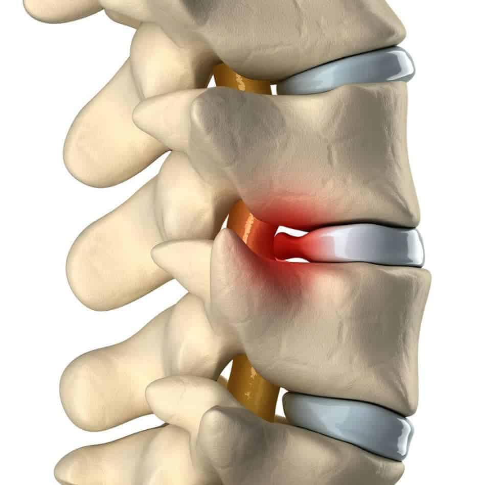 herniated-disc-bulding-disc-treatment