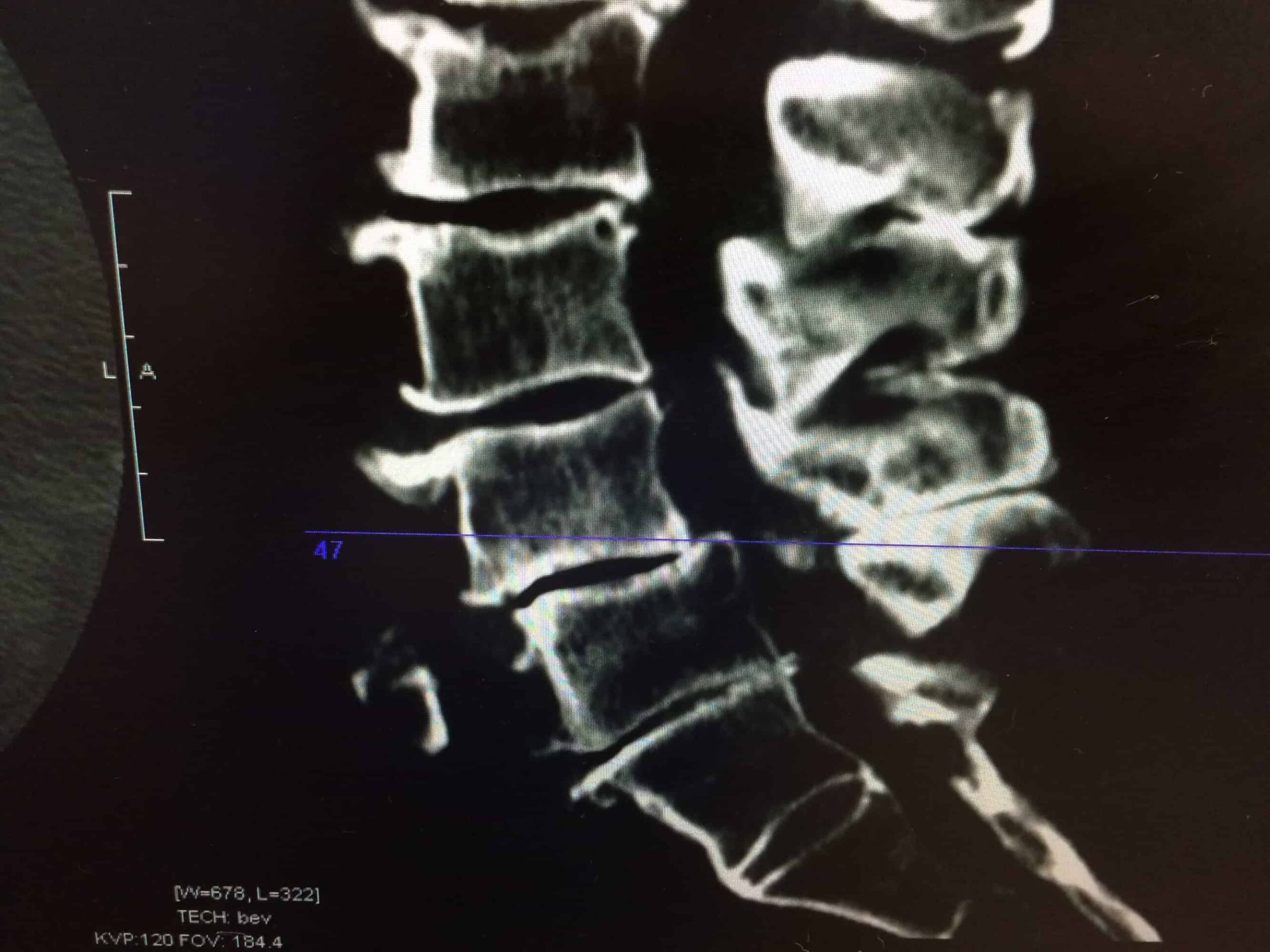 A section of an x-ray image that shows the lower vertebrae of a person's spine.