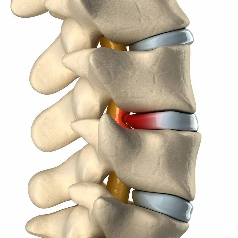 How to Sleep With a Herniated Disc - OrthoBethesda