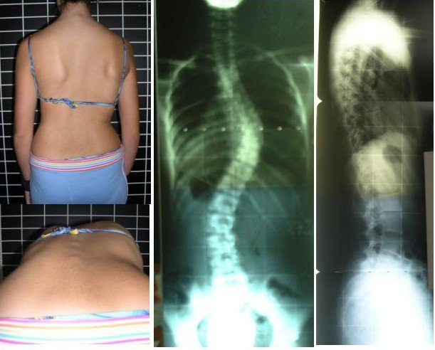 Healing Scoliosis with Yoga