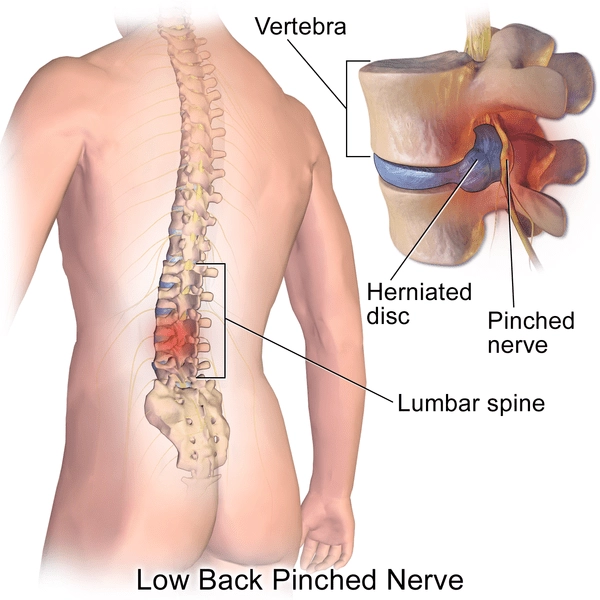 low back pain pinched nerve explained