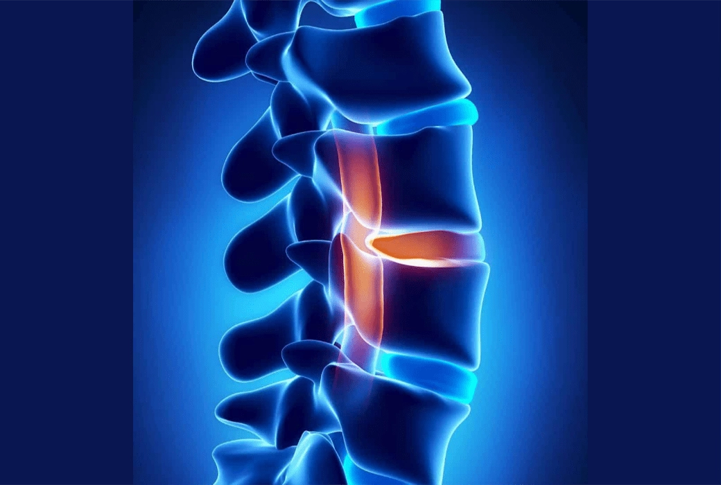 Herniated Disc Long Term Effects and Prognosis