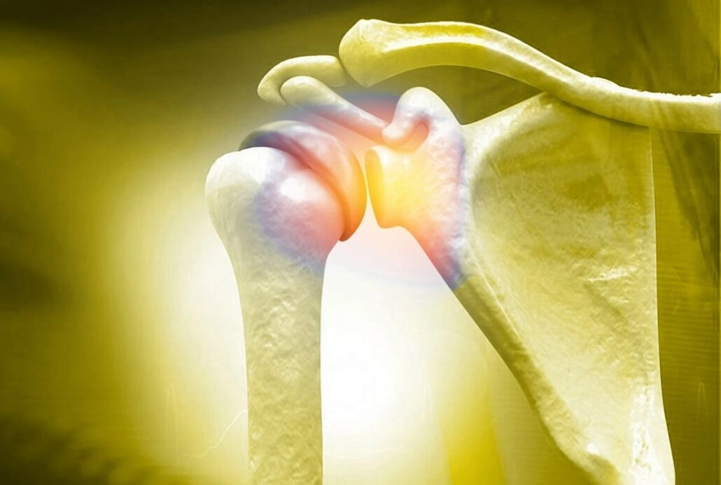 What Happens if a Torn Rotator Cuff Goes Untreated?