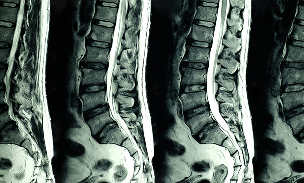 How To Cure Degenerative Disc Disease: Three Natural Methods