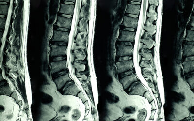 How To Cure Degenerative Disc Disease: Three Natural Methods