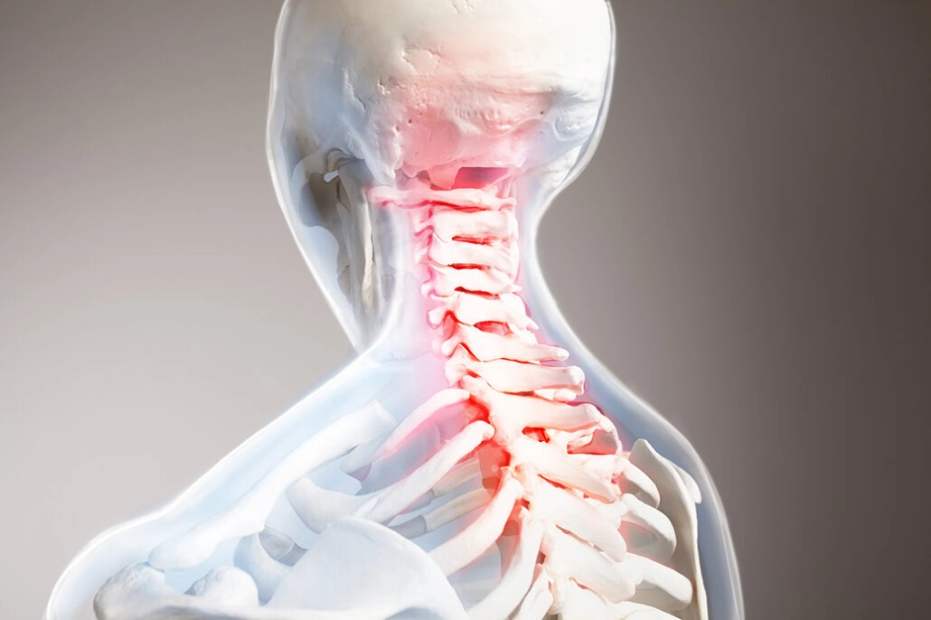 What Things Make Cervical Radiculopathy Worse