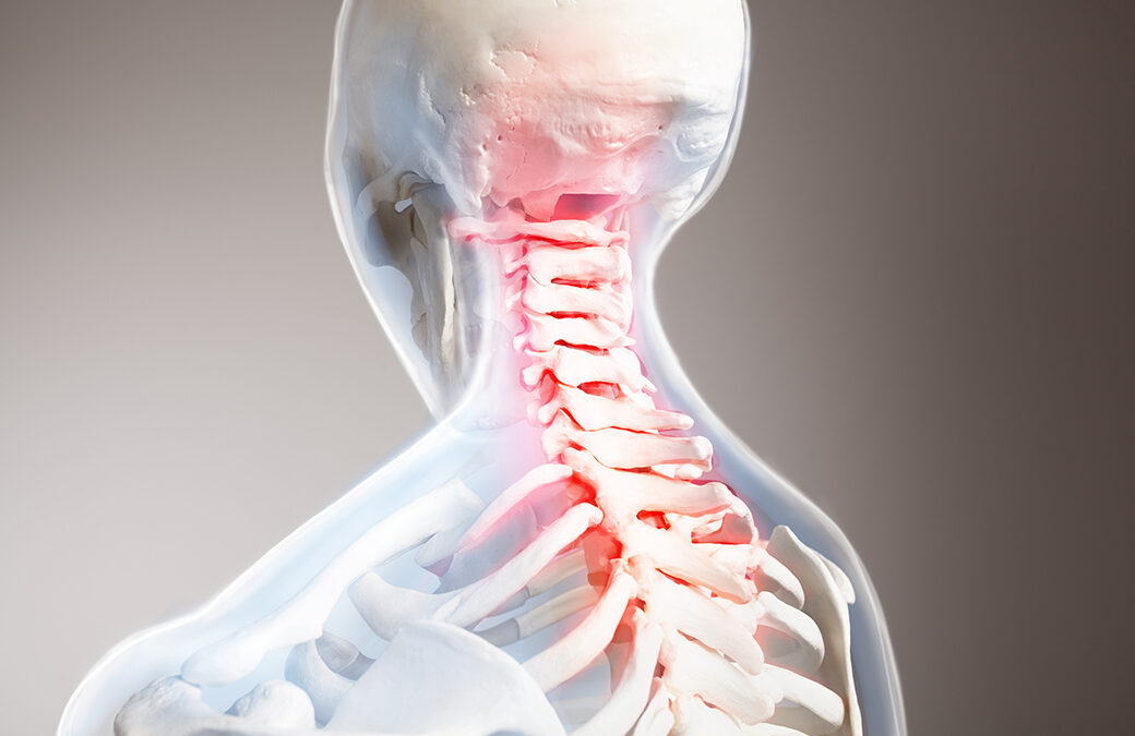 What Things Make Cervical Radiculopathy Worse?