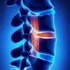 An x-ray representation of a human spine section with highlight in the discs.