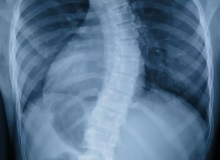 An x-ray image of a deformed spine.