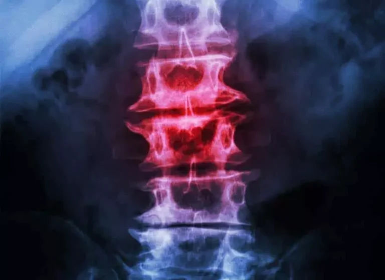 An X-ray image showing a spine with a section in red.