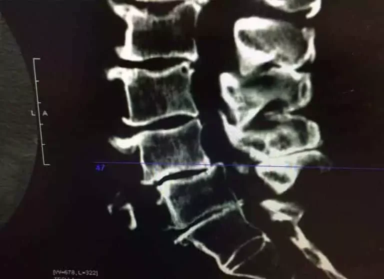 An x-ray imaging of a spine.