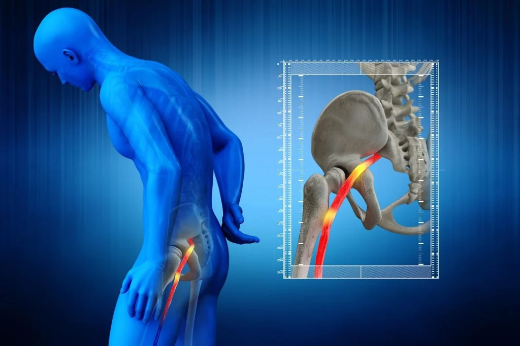 An x-ray anatomy image that shows the sciatic nerve as it runs through the pelvic bones.